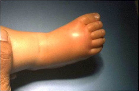 cellulitis hand child