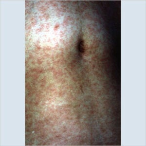 Measles Images | Immunize.org