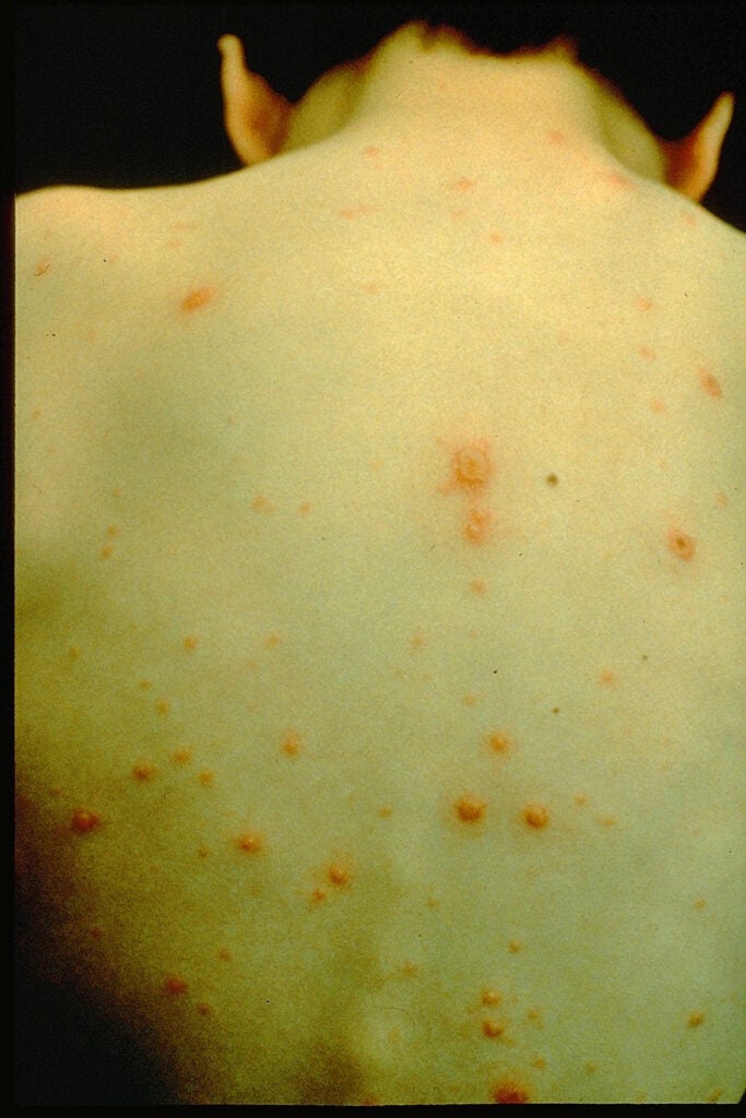 Varicella (Chickenpox) Images | Immunize.org